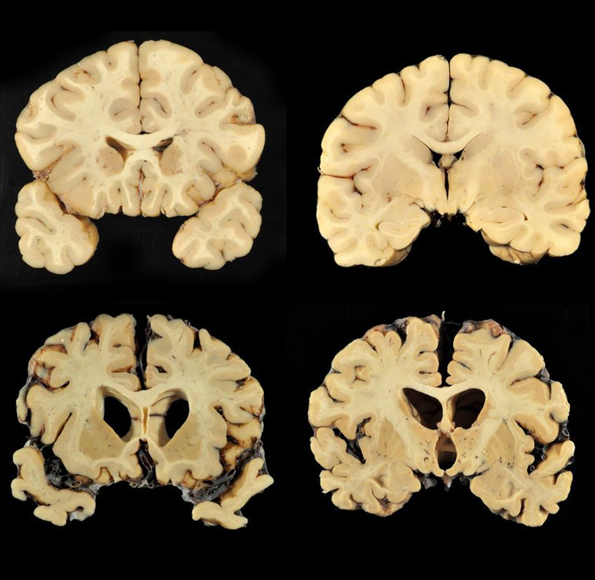 what-is-cte-brainline